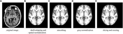 Early Detection of Alzheimer’s Disease Using Magnetic Resonance Imaging: A Novel Approach Combining Convolutional Neural Networks and Ensemble Learning